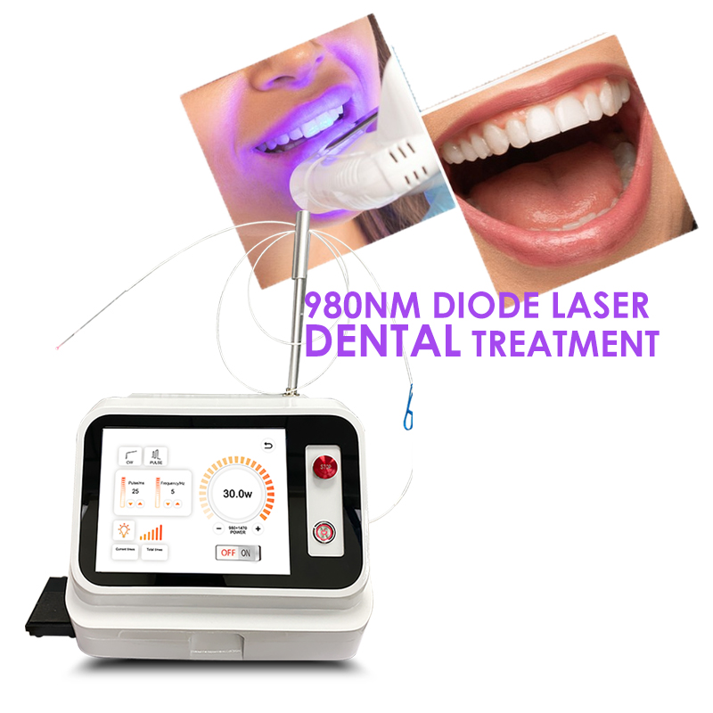 Teeth Whitening With Laser - 2024 Hot Sale Dental Soft Tissue
