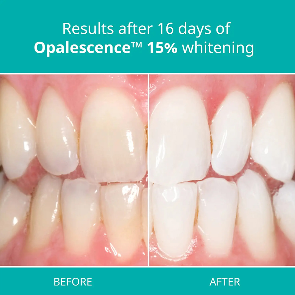 Opalescence Professional White - огляд і ціна Teeth Whitening Opalescence