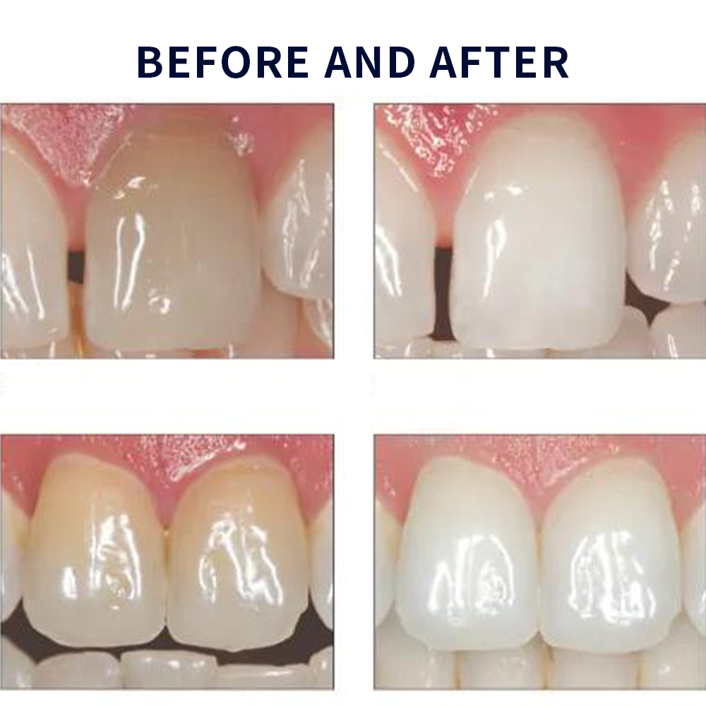 Opalescence Whitening 20% PF 2 - огляд і ціна Teeth Whitening Opalescence