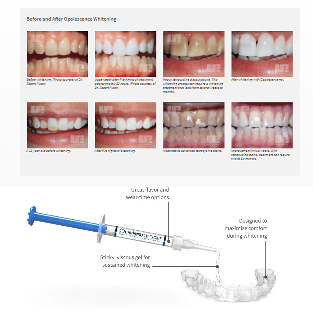 Opalescence Whitening 20% PF 2 - огляд і ціна Teeth Whitening Opalescence