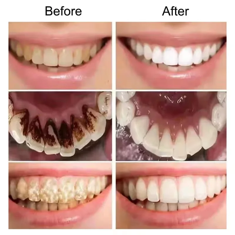 Teeth Whitening Toothpaste Rem - огляд і ціна Teeth Whitening Opalescence