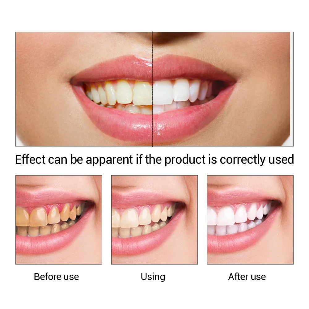 FTEENPLY Teeth Whitening Essen - огляд і ціна Teeth Paint Whitening
