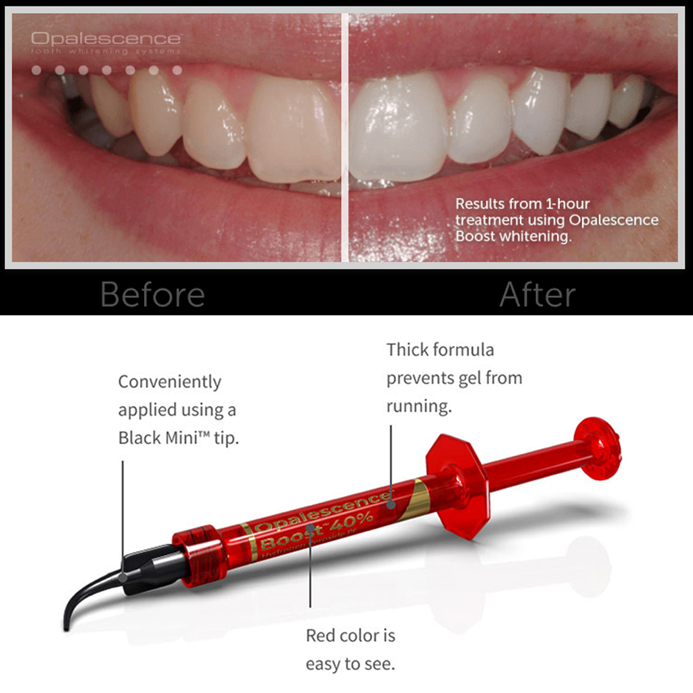 Ultradent Opalescence Boost PF - огляд і ціна Teeth Whitening Opalescence